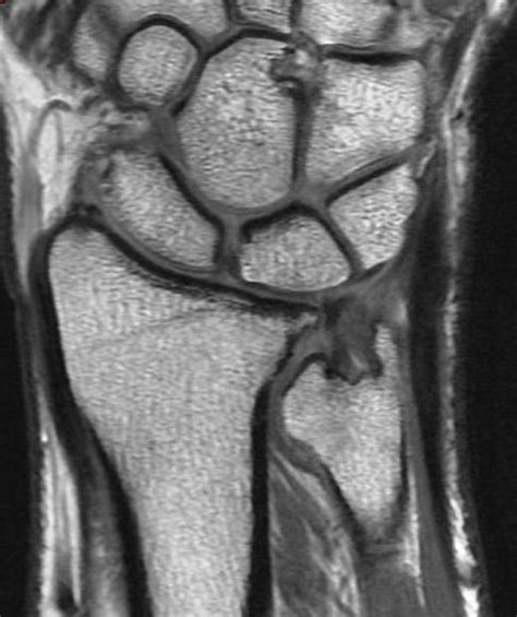 ulnar carpal impingement test